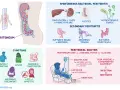 Ilustracja przedstawia anatomię otrzewnej, objawy zapalenia otrzewnej, przyczyny i dializę otrzewnową.