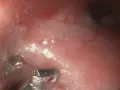 Endoskopowa ocena jelita grubego u psa z podejrzeniem IBD. Widoczne zmiany zapalne błony śluzowej.