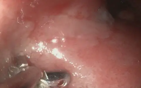 Endoskopowa ocena jelita grubego u psa z podejrzeniem IBD. Widoczne zmiany zapalne błony śluzowej.